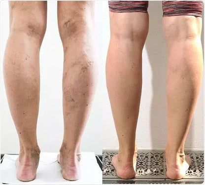 Rimedio Naturale in Bambù contro Gambe Gonfie e Vene Varicose